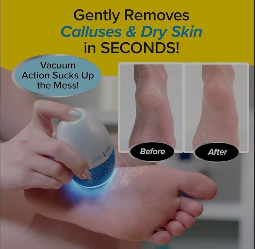 Callus Remover