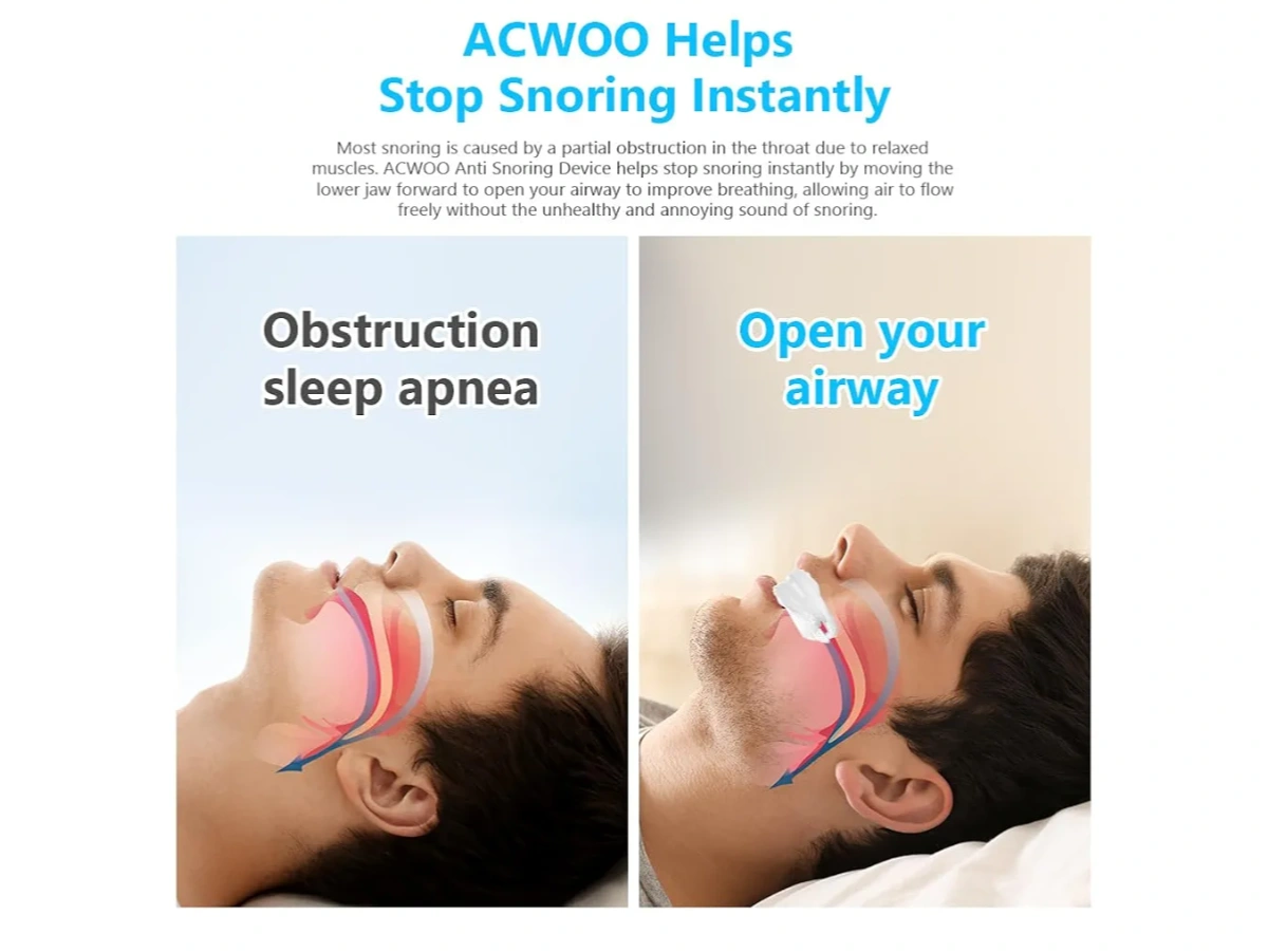 Anti-Snoring Devices