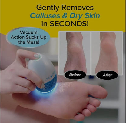 Callus Remover